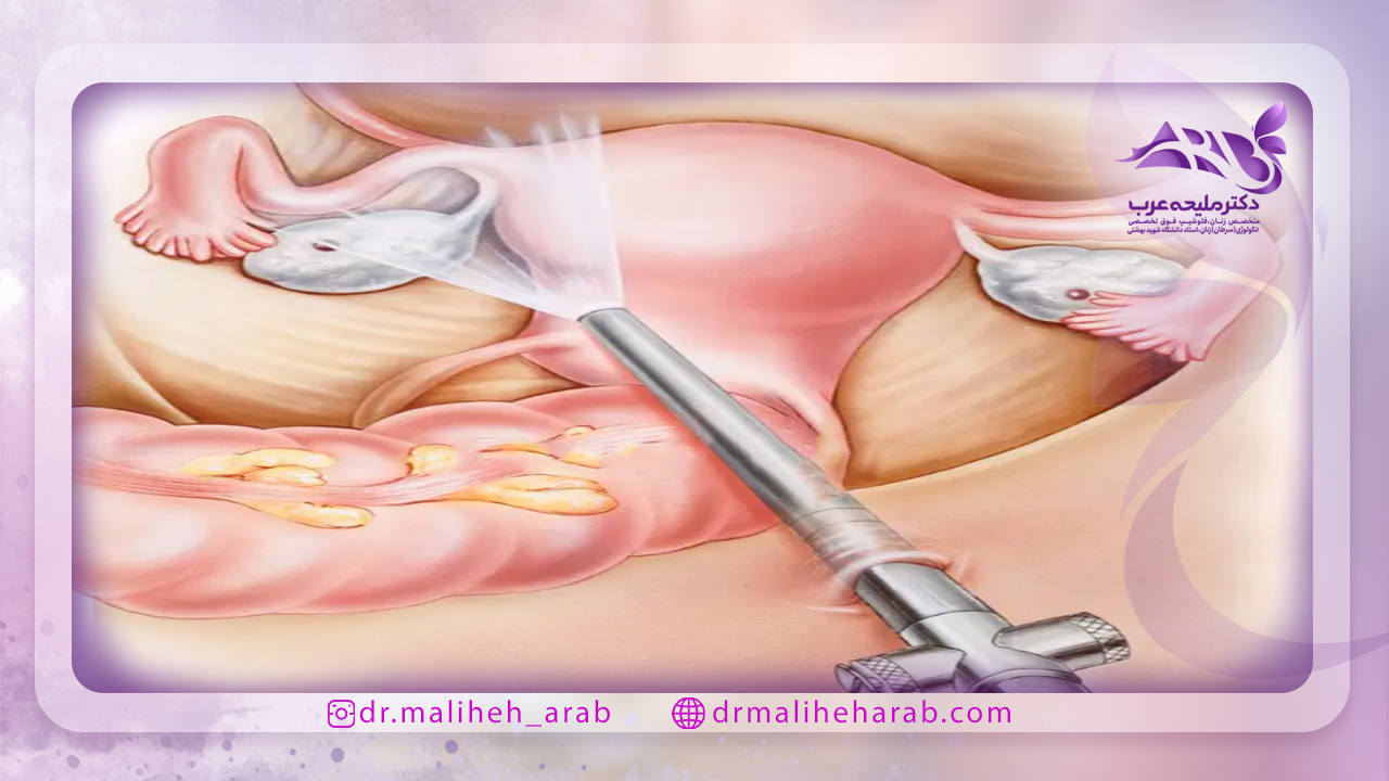 مزایای انجام لاپاراسکوپی