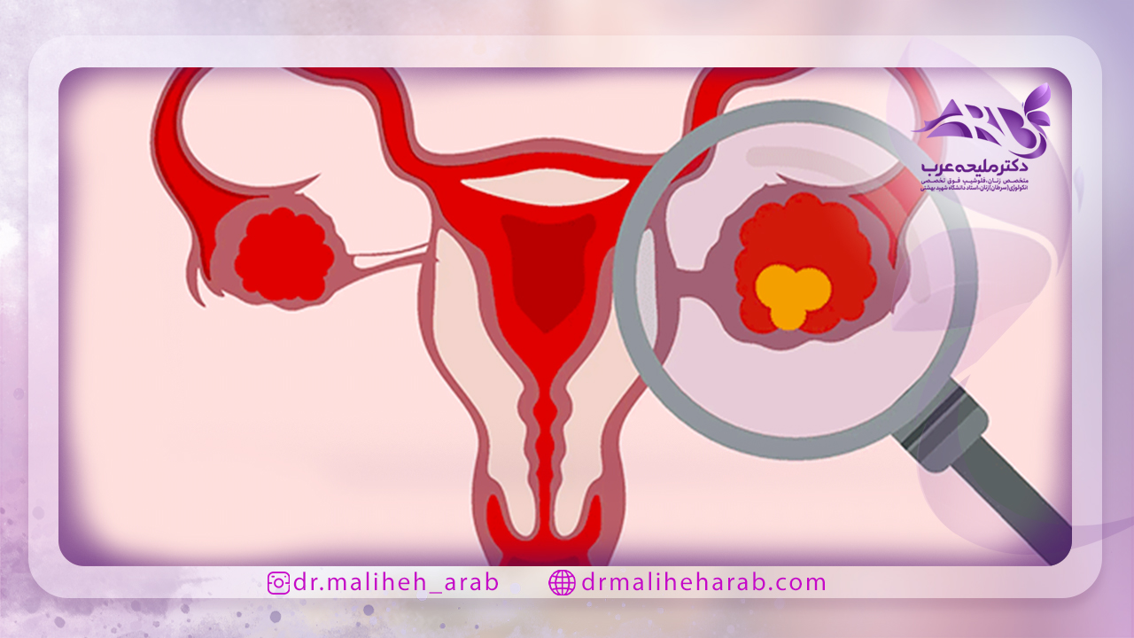 انواع کیستهای تخمدان