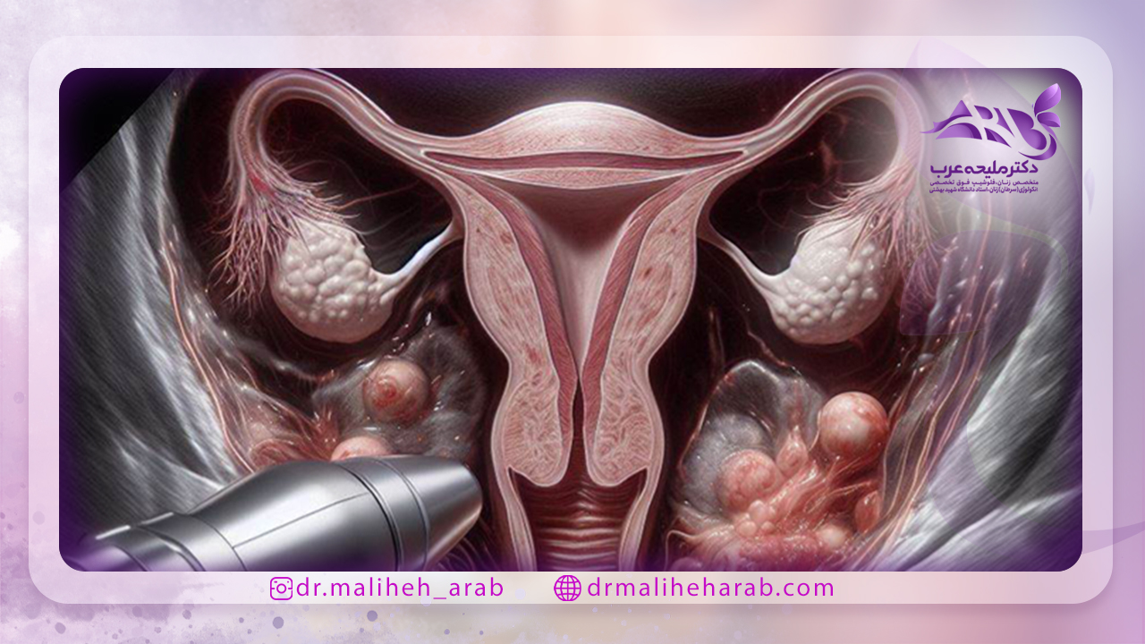علت بروز اندومتریوز