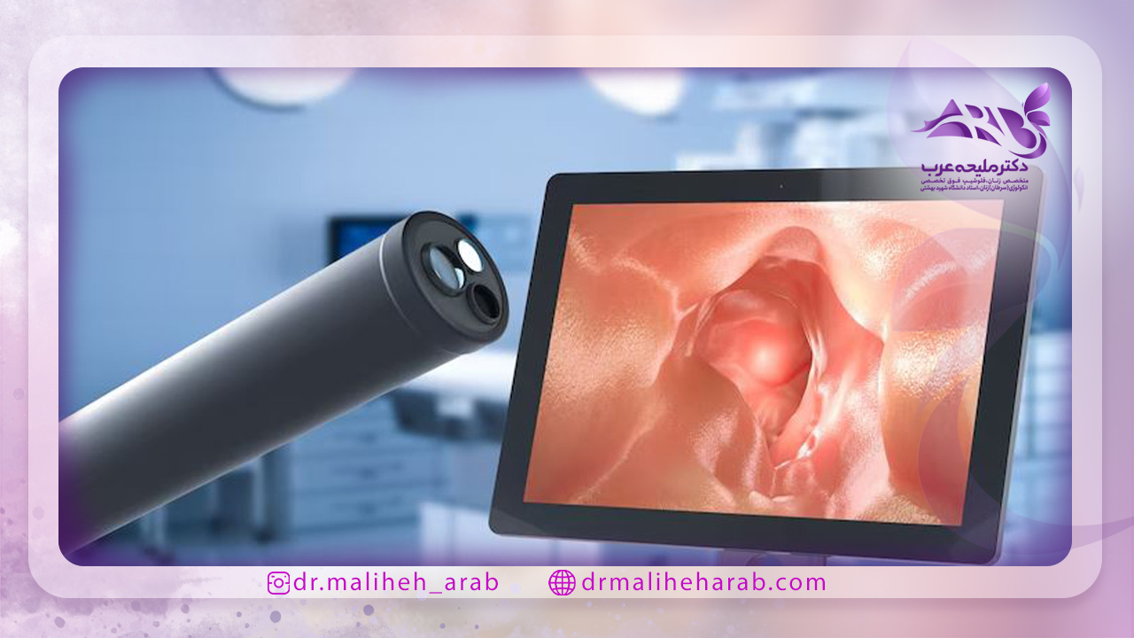 لاپاراسکوپی آندومتریوز